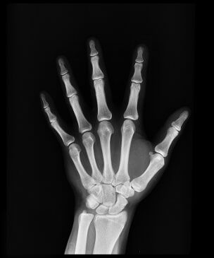 X-ray of bones of hand